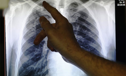 Winning the War on Tuberculosis 